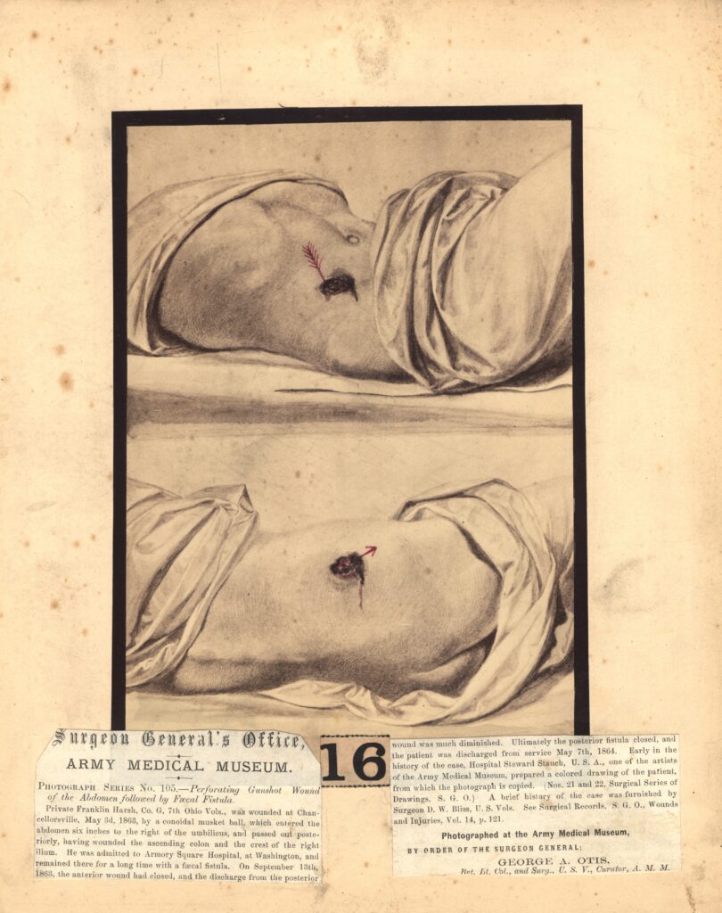 Wounds to human body by musket with entry and exit. Demonstrates lethality of musket ball.